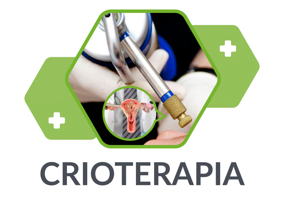 crioterapia-cervical
