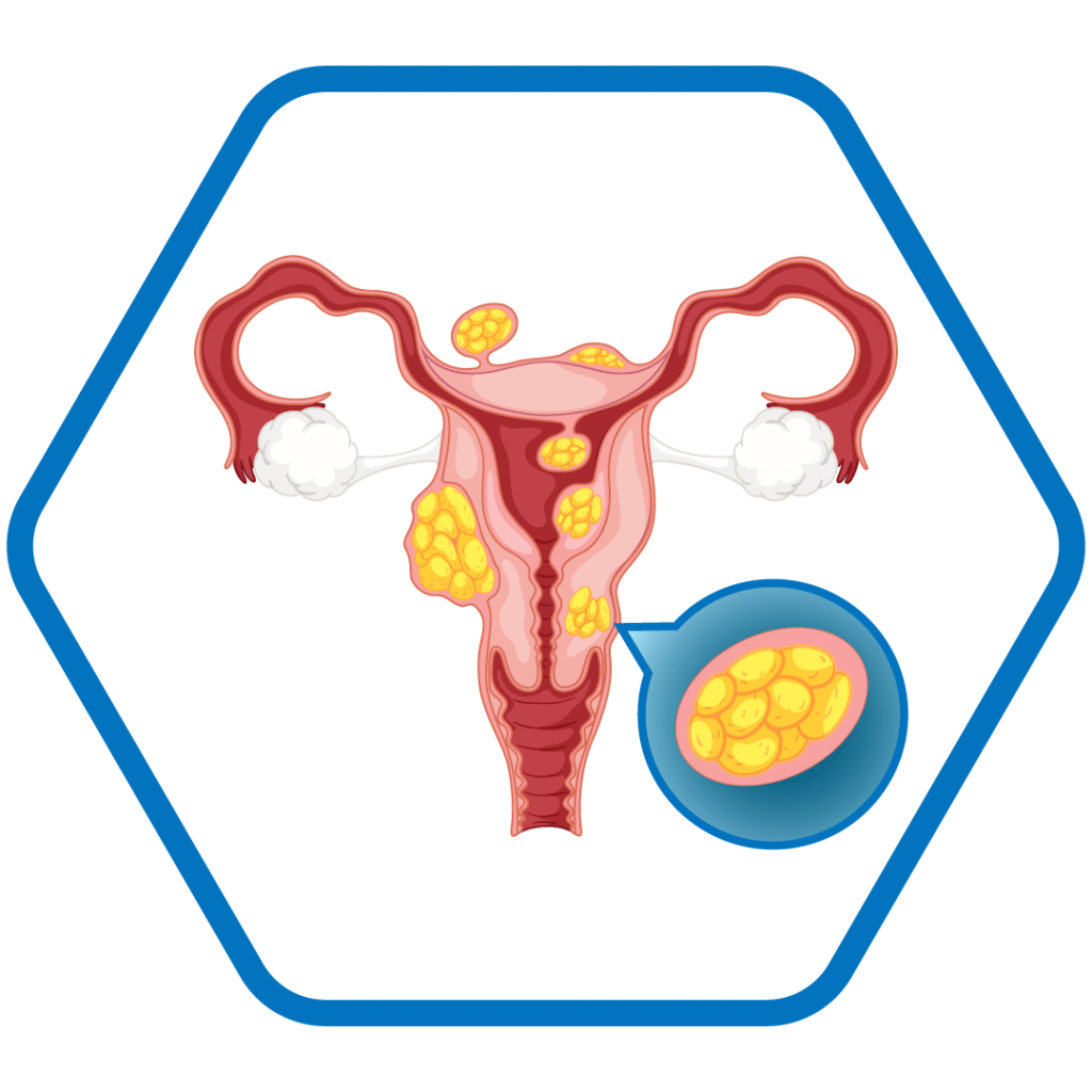Fibromatosis Uterina